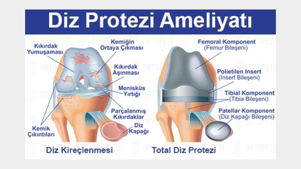Diz Protezi Ameliyatı: Tüm Süreç, Fiyatlar ve Ameliyat Sonrası İpuçları