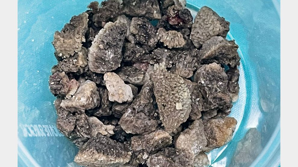 Taş Ocağı Gibi Böbrek!..
