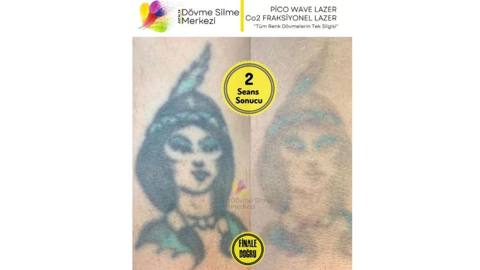 Antalya Dövme Silme Merkezi Lara Dövme Sildirme Uygulamalarında Nasıl Bir Yol İzliyor?